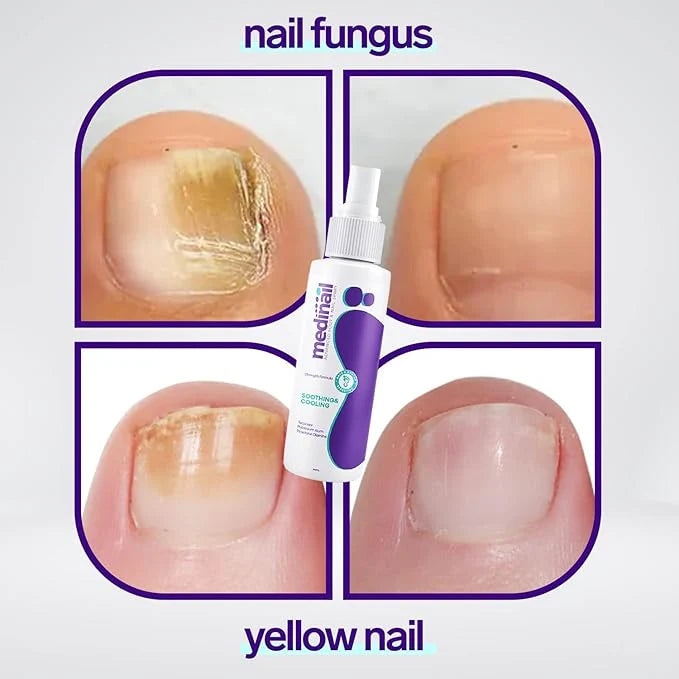 Anti-Fungal Nail Spray for Healthy, Clear Nails